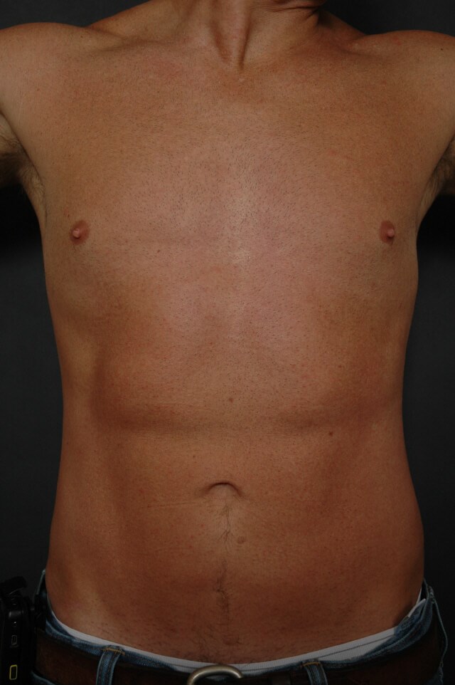 Liposuction - abs/love handles After