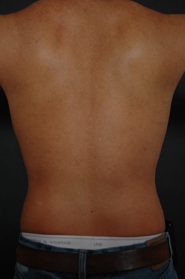 Liposuction - abs/love handles After