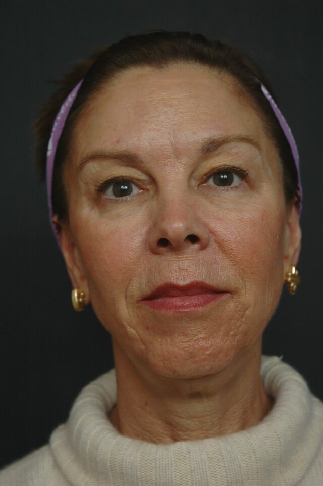 Full Facial Rejuvenation Before
