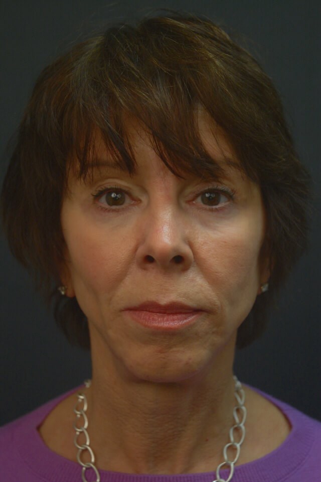 Full Facial Rejuvenation After