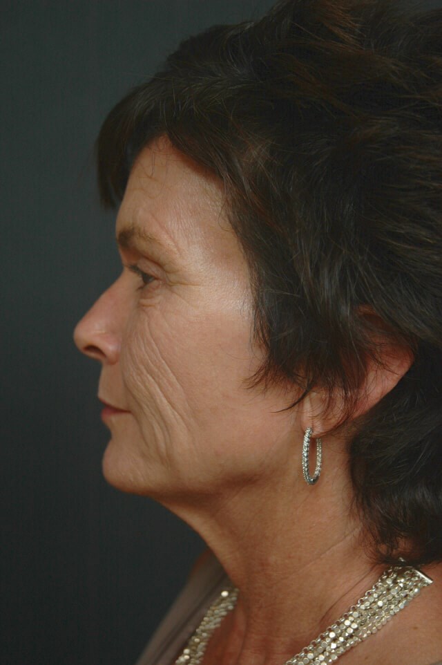 Full Face Rejuvenation Before
