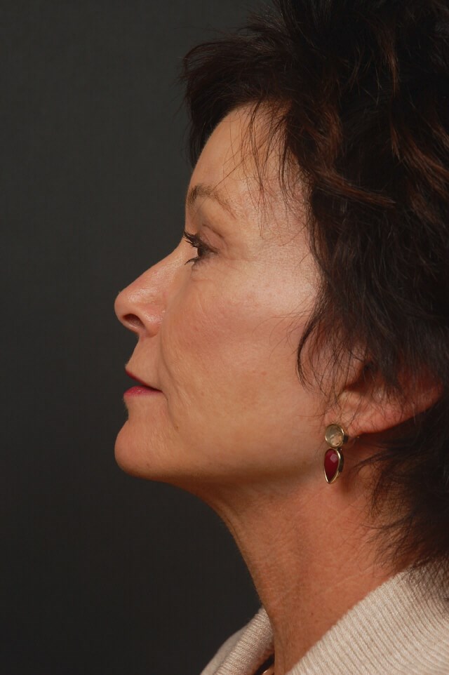 Full Face Rejuvenation After