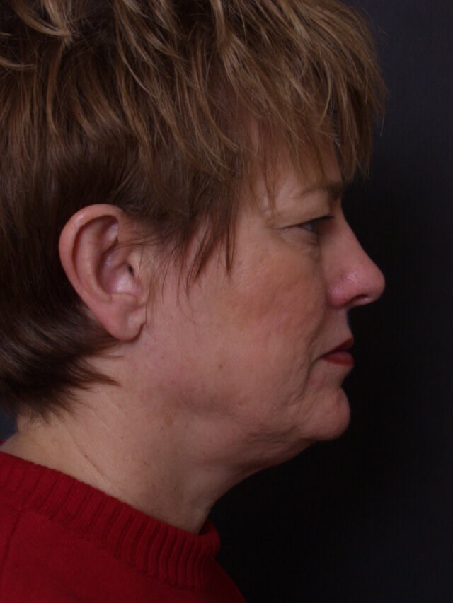 Face lift Before