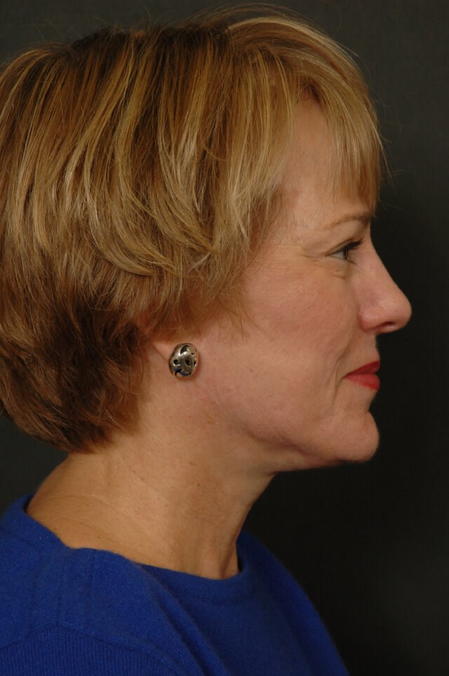Face lift After