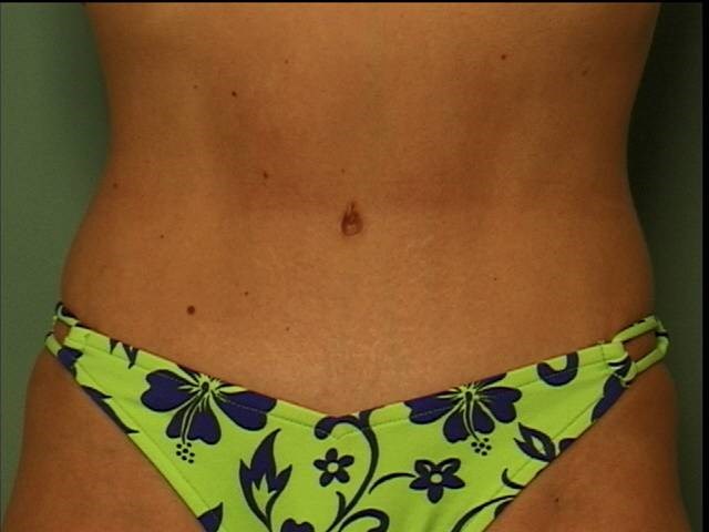 Tummy Tuck After