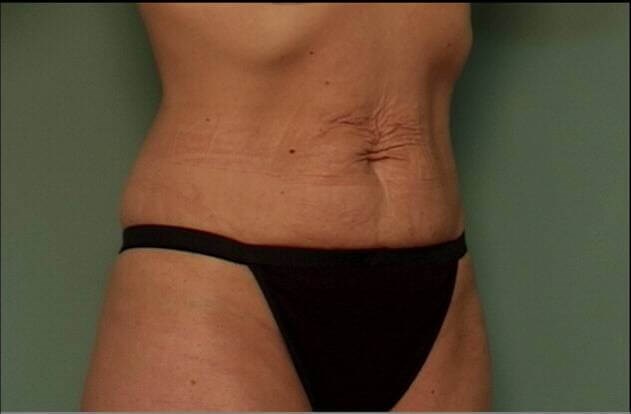 Tummy Tuck Before