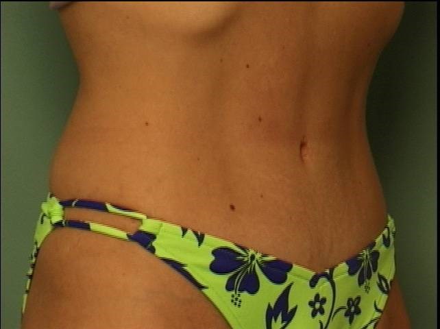 Tummy Tuck After