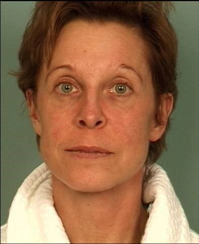Blepharoplasty After