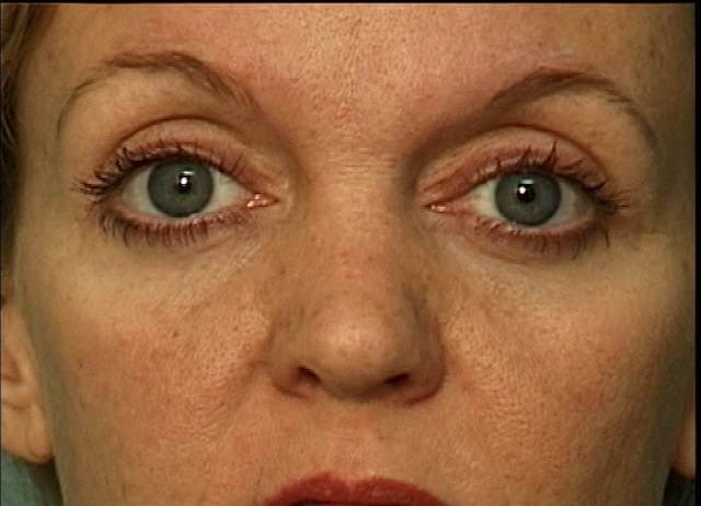 Blepharoplasty After