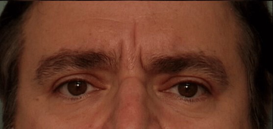 Botox - Glabella Before