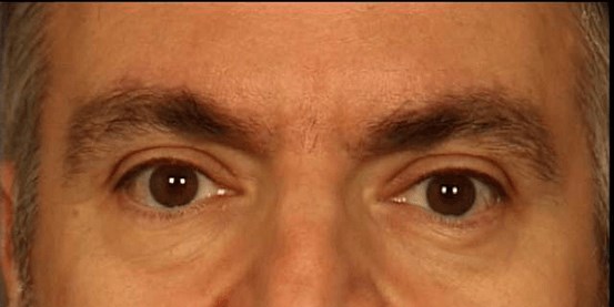 Botox - Glabella After