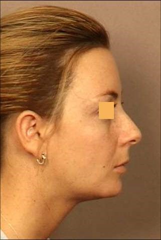 Chin Implant After