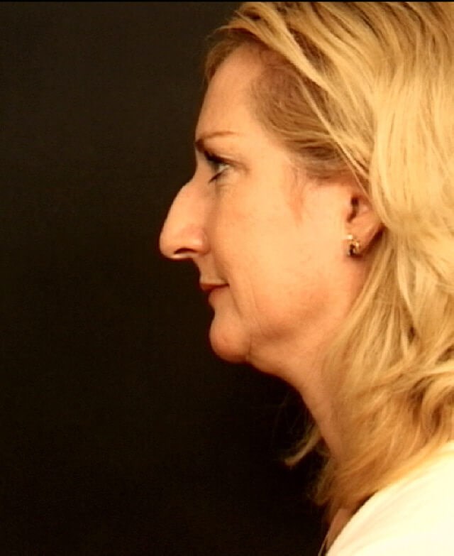 Rhinoplasty Before