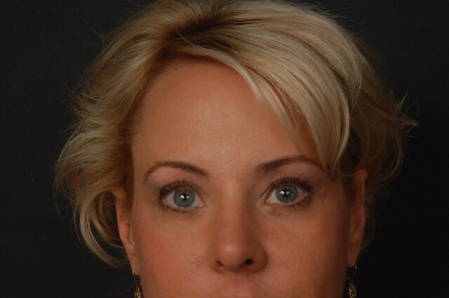 Blepharoplasty After